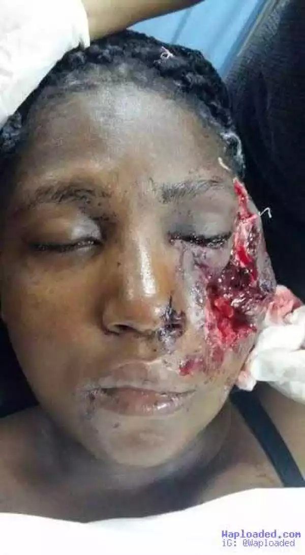 So Sad!! See How Beautiful Poly StudentLoses Left Eye From Robber’s Bullet In Delta [Graphic Photos]
